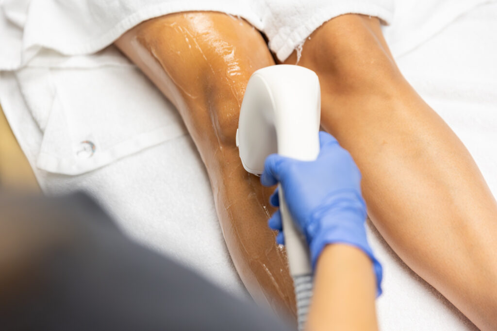 Laser hair removal treatment at a beautiful you