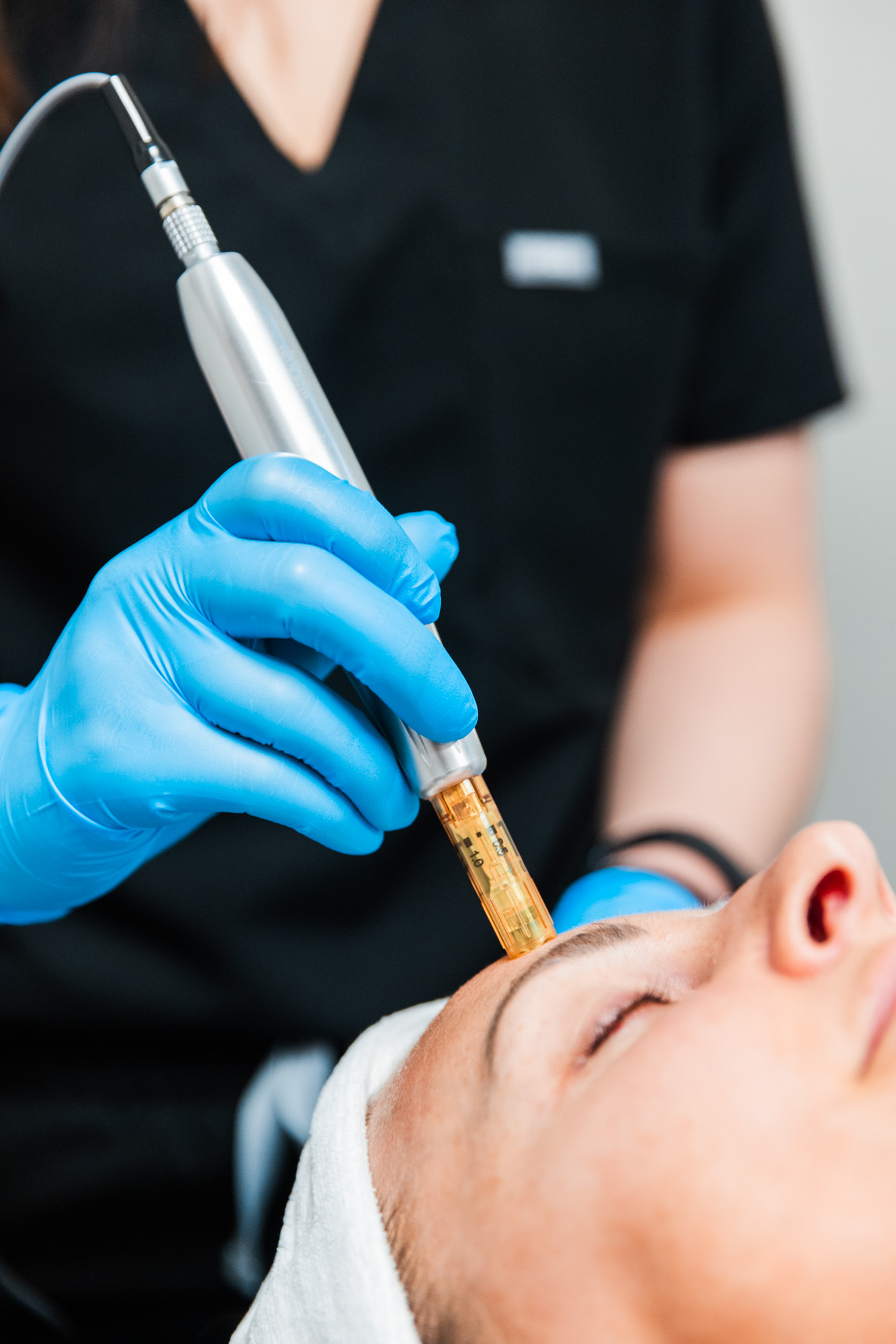 Microneedling treatment