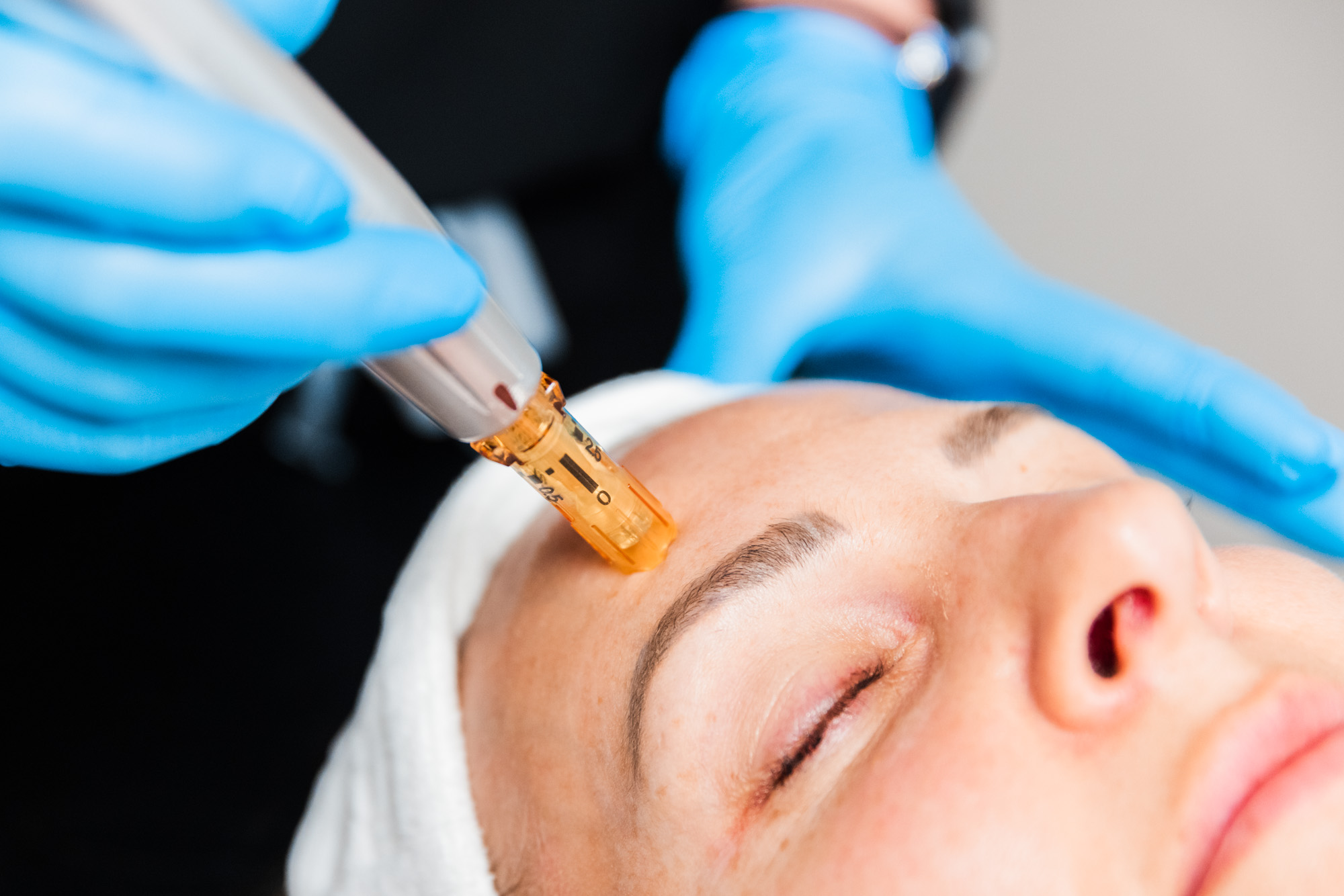 close up of a microneedling treatment