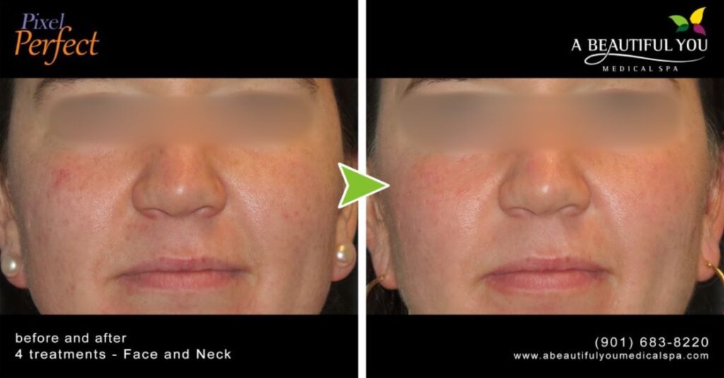 Pixel Skin Resurfacing A Beautiful You Medical Spa