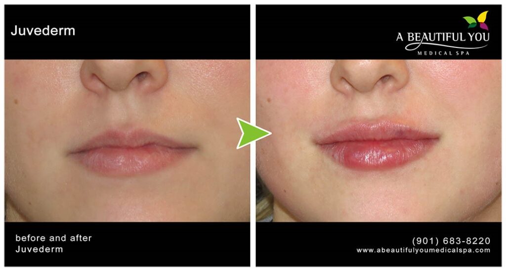 Injectables, Filler Lips