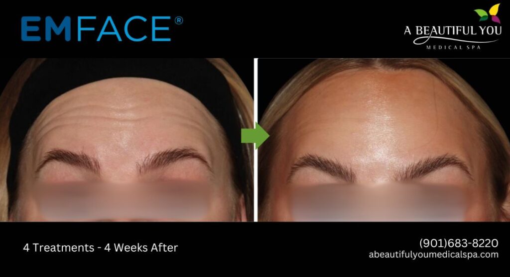 A Beautiful You Medical Spa EMFACE Lift