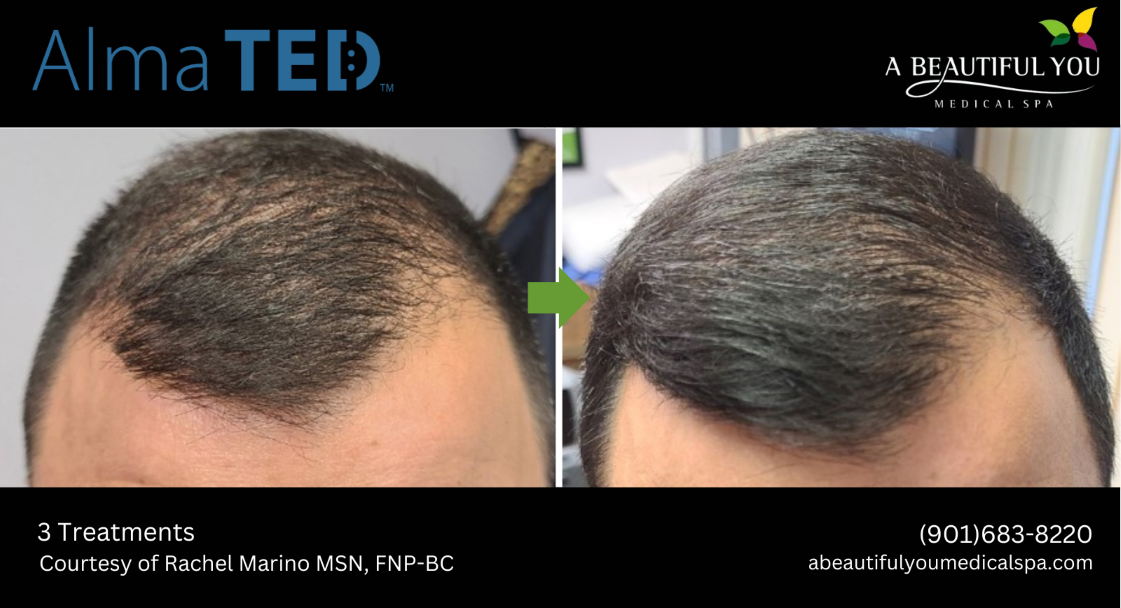 TED Hair Restoration