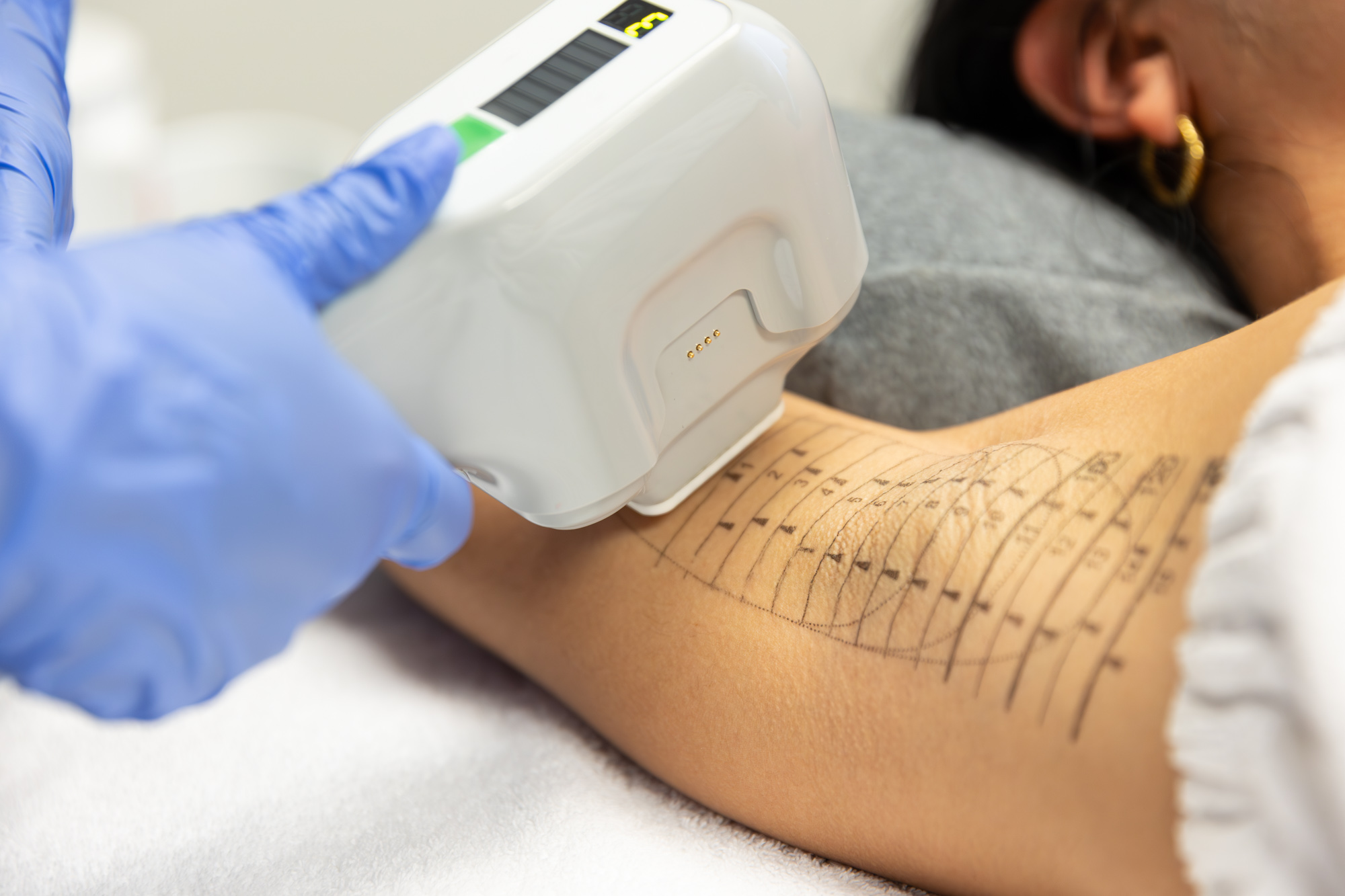 A woman's underarm as she is recieving hyperhidrosis treatment in Germantown, TN with miraDry