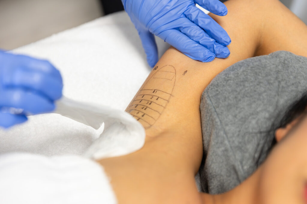 Close up of hyperhidrosis treatment in memphis on a womans underarm