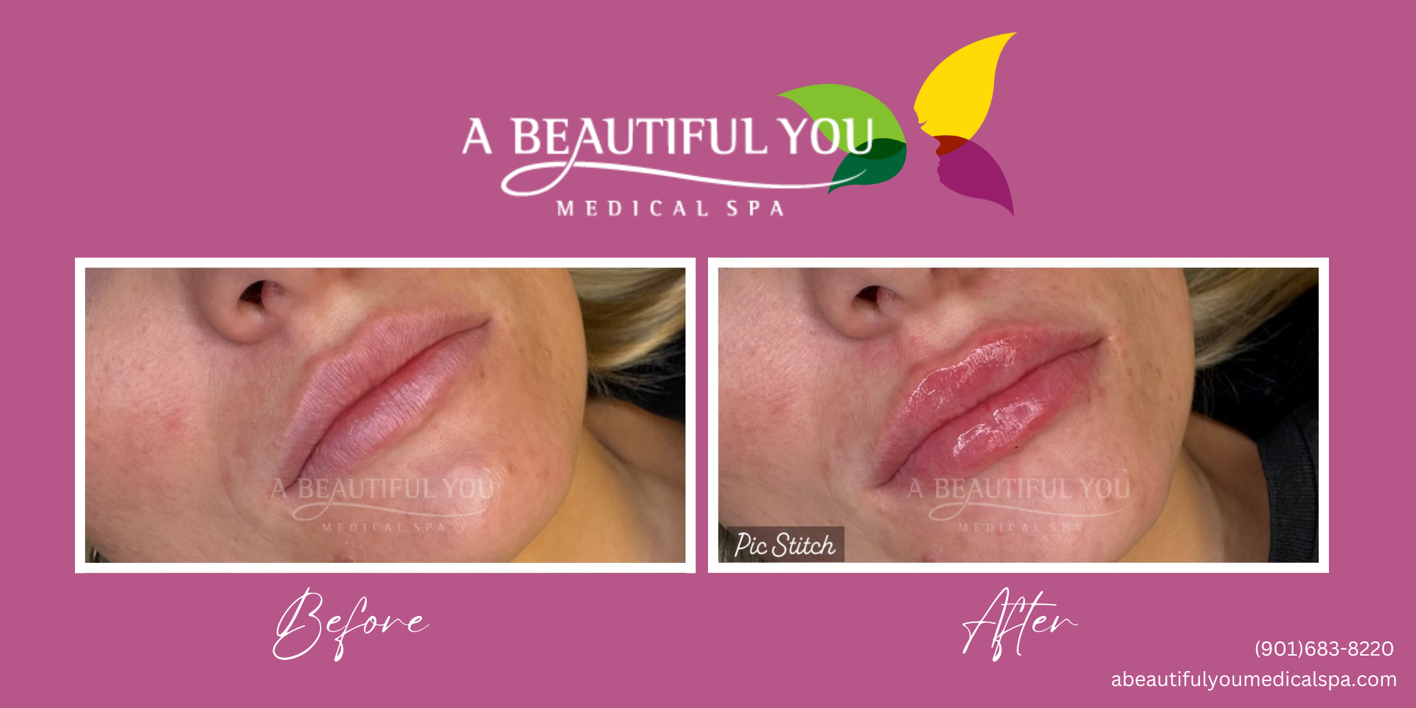 Dermal Filler Lips